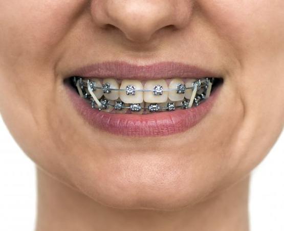 Up-close view of traditional braces with rubber bands