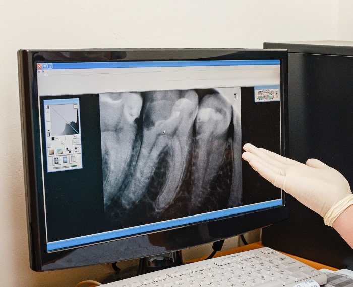 Digital x rays on chairside computer monitor