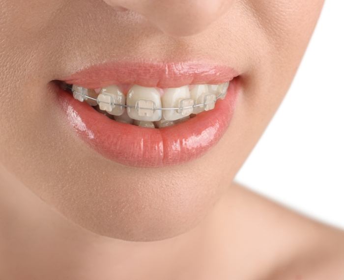 Closeup of smile with clear and ceramic braces