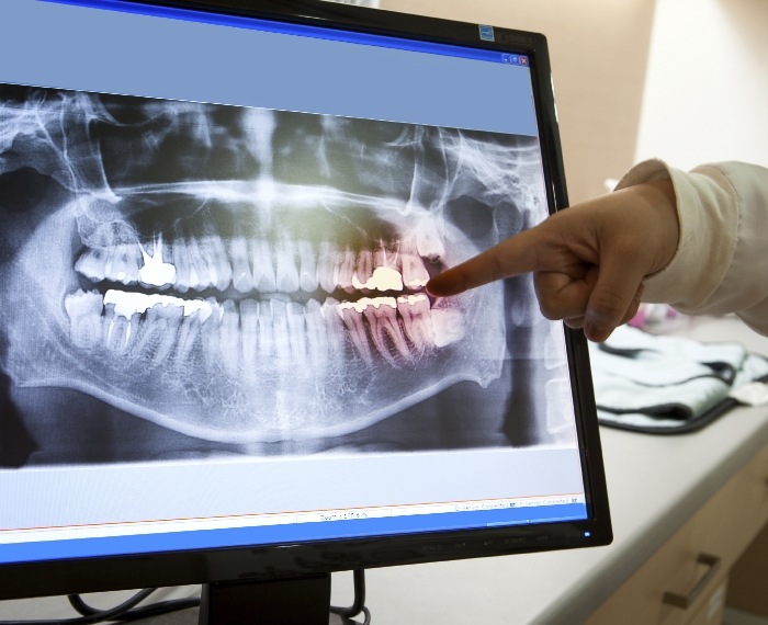 Digital x rays on chairside computer monitor