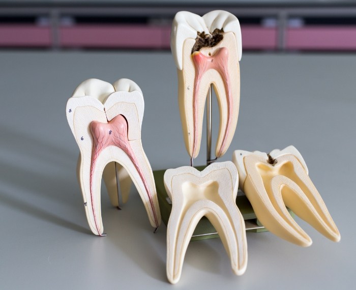 Model healthy tooth compared to tooth in need of root canal treatment