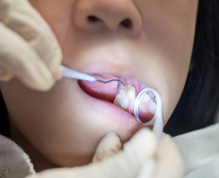 Pediatric dentist examining smile after tooth colored filling