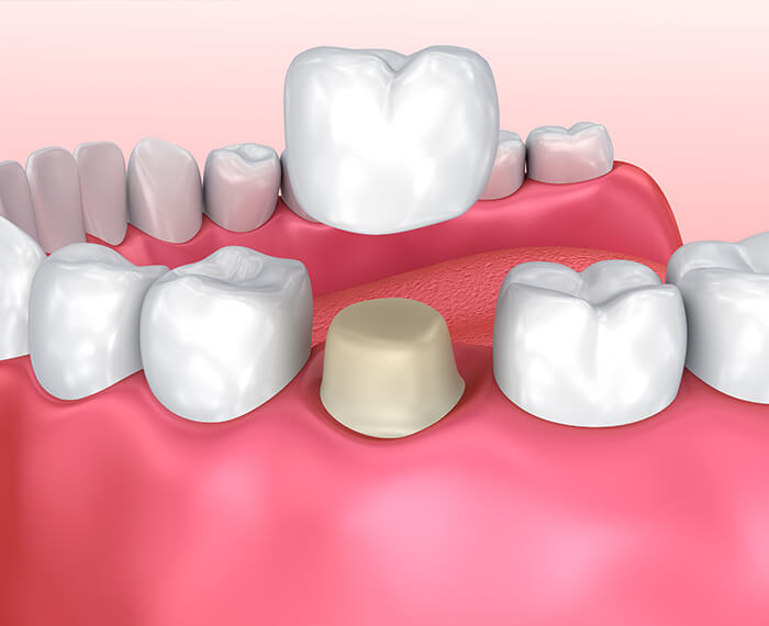 Animated smile during dental crown placement