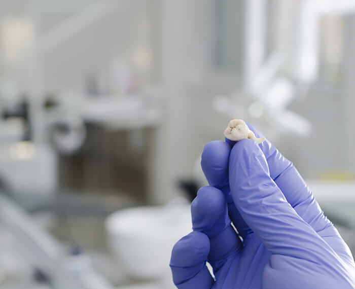 Hand holding a tooth after extraction