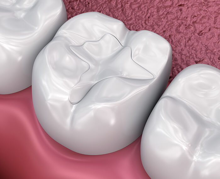 Animated smile with tooth colored fillings