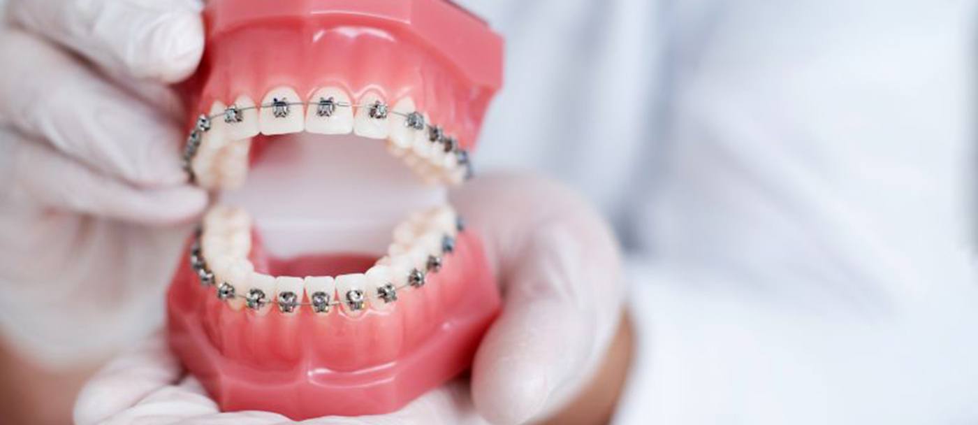 Gloved hands holding dental model with braces