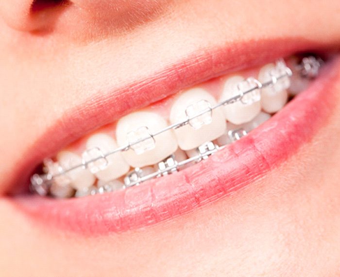 Close up of set of braces