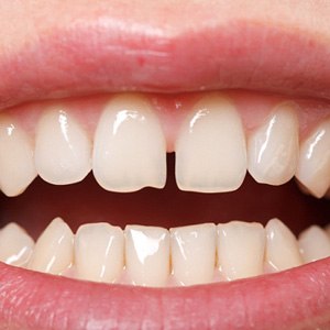 Picture of someone with gapped teeth